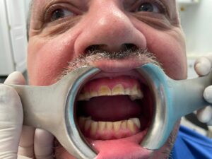 full-mouth-rehab-by-dr-Mo-bayside-dental-img
