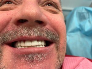 full-mouth-rehab-by-dr-Mo-bayside-dental